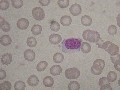 echinocytes