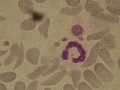 Schizocytes