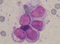 Leucémie à grands lymphocytes granuleux