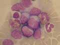 Leucémie lymphoïde