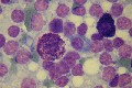mastocyte dans un NL