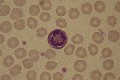 eosinophile toxique