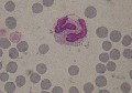 eosinophile lysé